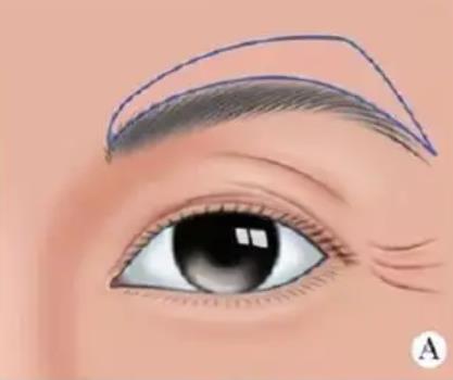 提眉術(shù)和縫合提眉術(shù)哪個好?免縫合提眉怎么做的?