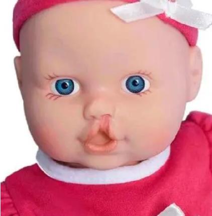 唇腭裂怎么辦?修復(fù)后有唇畸形怎么辦?