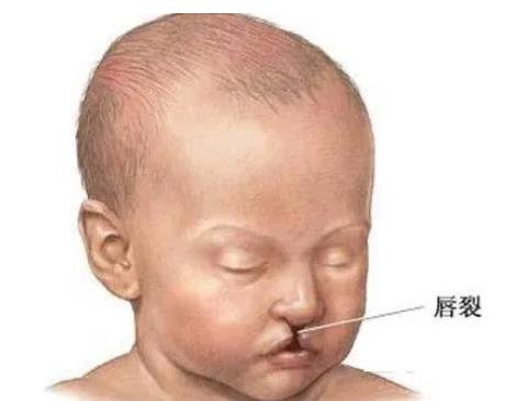 唇裂手術(shù)前的注意事項(xiàng)有哪些?