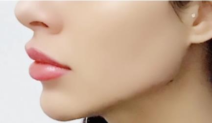 寬下頜角的整形果好嗎?頜面整形需要注意什么?