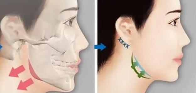 下頜角切除多少錢?下頜角切除術后護理有哪些要注意的?
