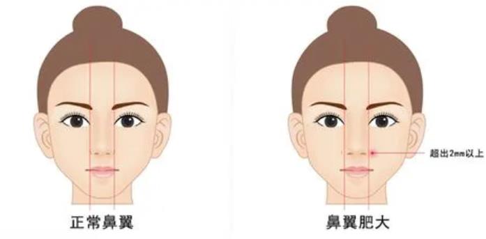 鼻翼縮小手術(shù)的注意事項(xiàng)有哪些?