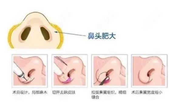 鼻翼內(nèi)切是切鼻基底嗎，有哪些注意事項(xiàng)?
