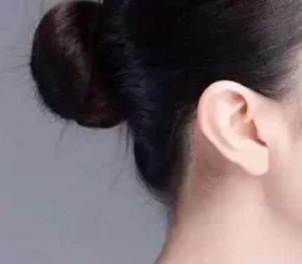 玻尿酸豐耳垂的危害和副作用是什么?