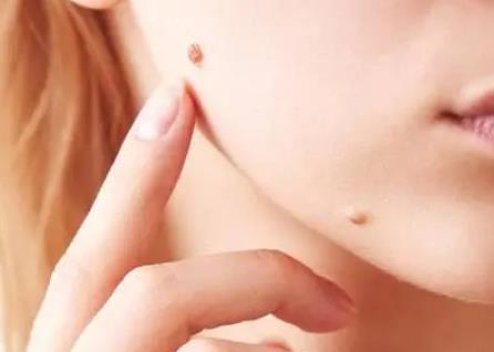 點(diǎn)痣的優(yōu)缺點(diǎn)分別是什么?