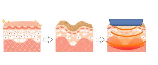 電波拉皮的作用是什么?有哪些危害