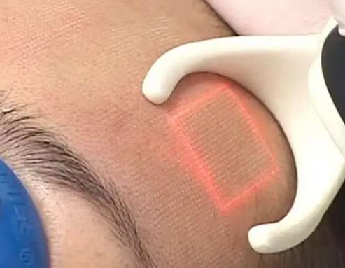 點(diǎn)陣激光疼嗎，點(diǎn)陣激光有什么優(yōu)點(diǎn)?