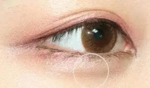 注射玻尿酸的臥蠶會(huì)不會(huì)下移?