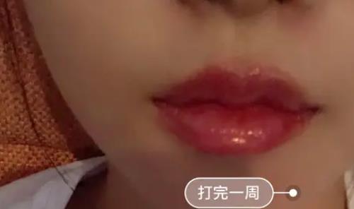 玻尿酸豐唇珠會(huì)留下疤痕嗎?