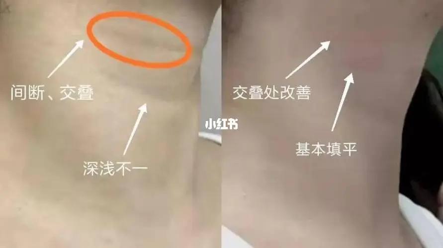 嗨體去除頸紋是*性的嗎？嗨體打淚溝有哪些應該注意