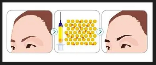 眉弓填充會(huì)不會(huì)有不均勻，眉弓填充的手術(shù)方法有哪些?