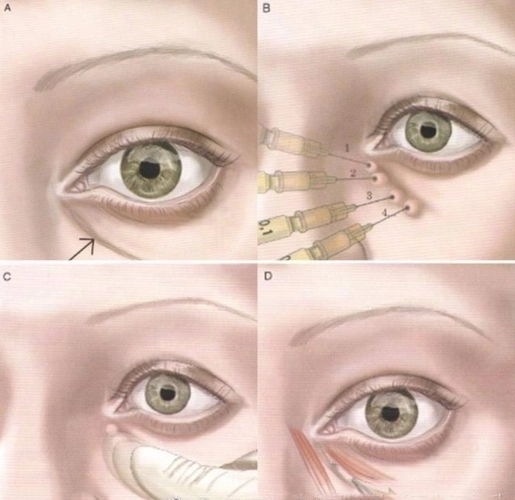 淚溝是眼袋嗎?填充淚溝危險嗎?