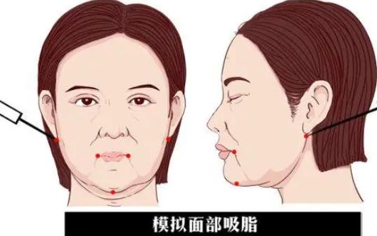 面部吸脂會(huì)不會(huì)反彈?