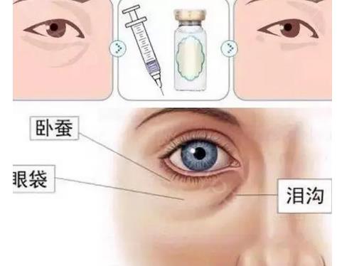 自體脂肪填充淚溝的維持時間有哪些影響因素?