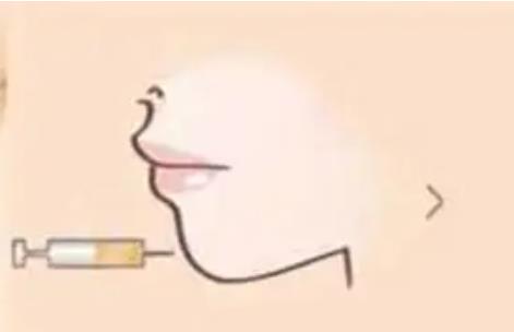 自體脂肪能豐下巴嗎?