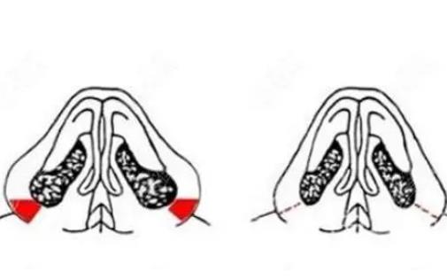 鼻翼縮小有什么后遺癥嗎