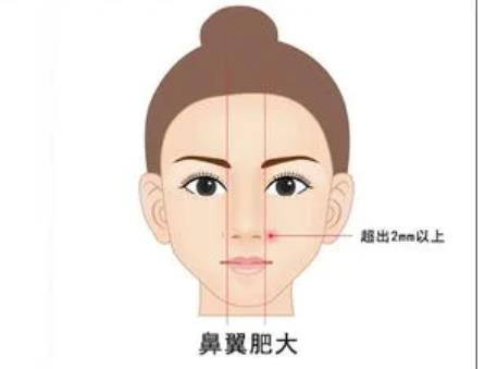 矯正朝天鼻的手術(shù)方法有哪些