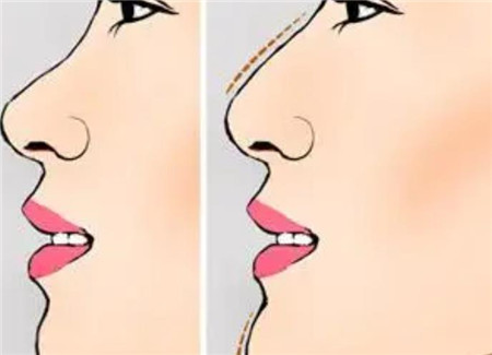 玻尿酸注射隆鼻有哪些風(fēng)險(xiǎn)?