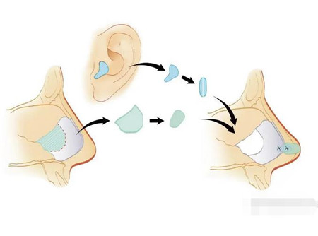 墊鼻基底的果怎么樣