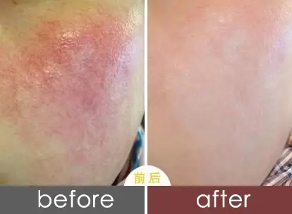 激光去紅血絲后應(yīng)該怎么護(hù)理呢?