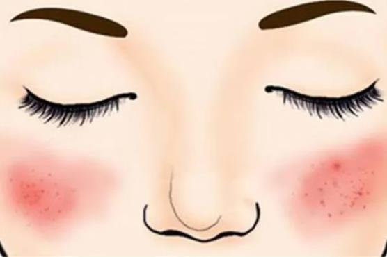 怎么避免激光去除紅血絲后復(fù)發(fā)？去除紅血絲有什么秘方?