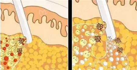 手臂抽脂之后什么時候能消腫