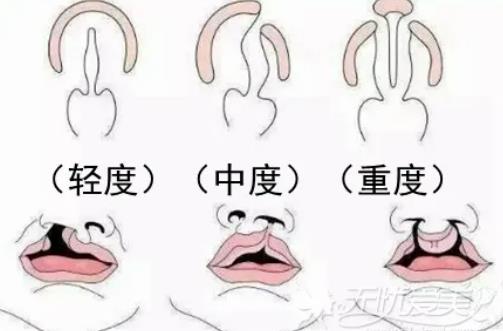 調(diào)節(jié)唇腭裂的合適的時(shí)機(jī)是多久?