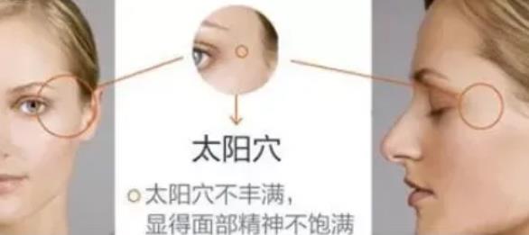 太陽穴填充有哪些條件，改變太陽穴凹陷的方法有哪些