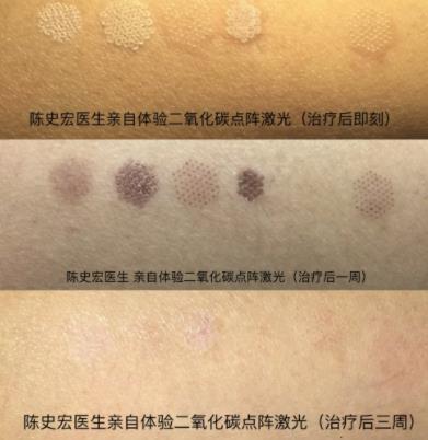 點(diǎn)陣激光去痘印有什么副作用?需要多長(zhǎng)時(shí)間恢復(fù)?