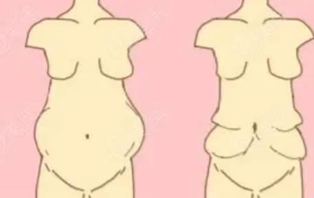 腹壁整形有哪些手術(shù)方法