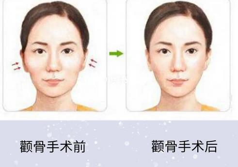 哪些情況適合顴骨整形手術(shù)?