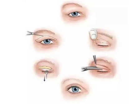 開眼角恢復期有什么注意事項