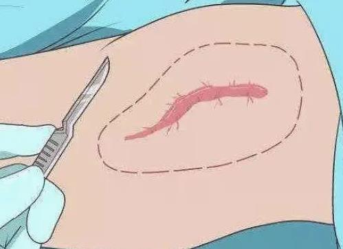 點陣激光祛疤有哪些優(yōu)點，多久可以看見效果