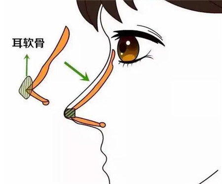 什么樣的假體適合做鼻整形手術(shù)