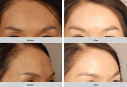 額頭填充脂肪能維持多長時間？