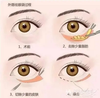 外切眼袋疤痕多久恢復(fù)？