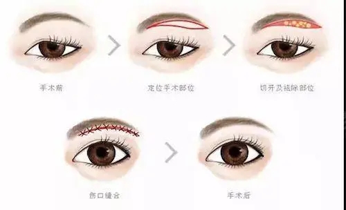 提眉5年后什么樣？提眉手術(shù)果能維持幾年？