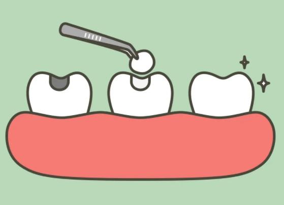 2022補牙多少錢一顆牙？補牙的方法和價位詳解！