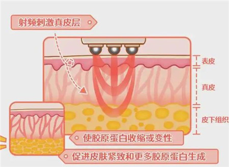 熱瑪吉的原理是什么?優(yōu)點有哪些?注意事項有哪些?