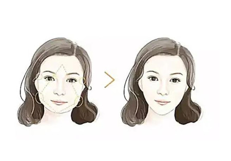 顴骨內(nèi)推的原理是什么?有什么注意事項?