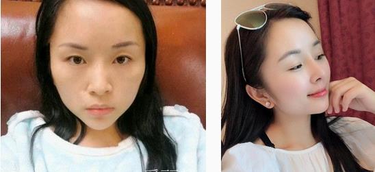 自體脂肪面部填充術前后果對比：更顯年輕和飽滿