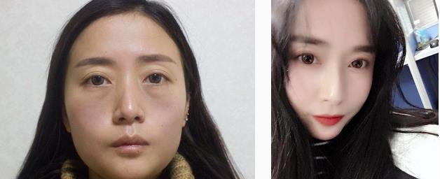 自體脂肪填充全臉手術前后果對比：術后的變化真的太大了