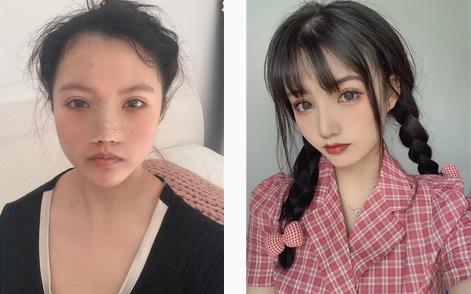 耳軟骨隆鼻手術(shù)前后果對(duì)比：終于有了卡哇伊的臉蛋兒