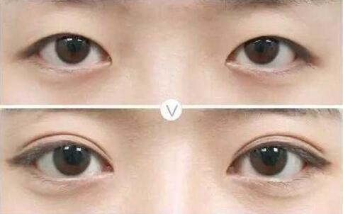 雙眼皮修復(fù)高不?什么時(shí)候修復(fù)雙眼皮比較好?