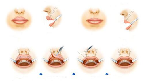 重唇是什么?做重唇矯正有什么風險?