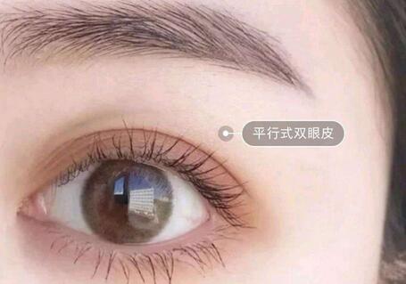 修復(fù)埋線雙眼皮的方法是什么?