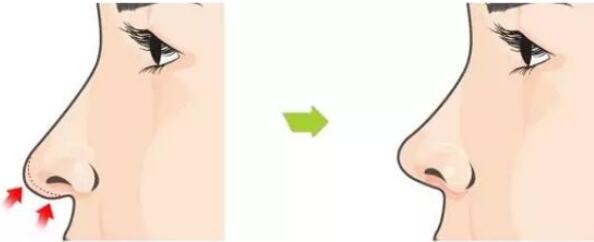 廣州鼻尖整形手術的操作流程是怎樣的?