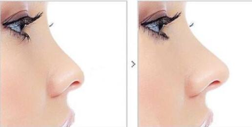 鼻尖整形多少錢?鼻尖整形常用的材料有哪些?
