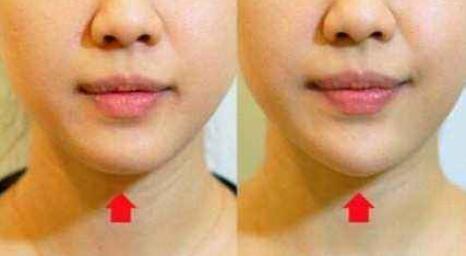 玻尿酸填充下巴恢復(fù)自然需要多久?