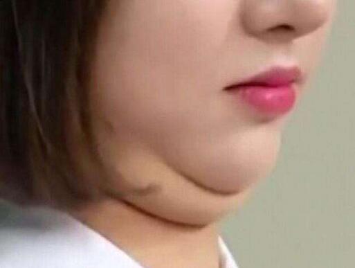 廣州雙下巴抽脂價(jià)格?雙下巴吸脂術(shù)后的護(hù)理要注意什么?